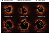 Intravascular Lithotripsy Shows Good Safety at 30 Days: DISRUPT CAD II